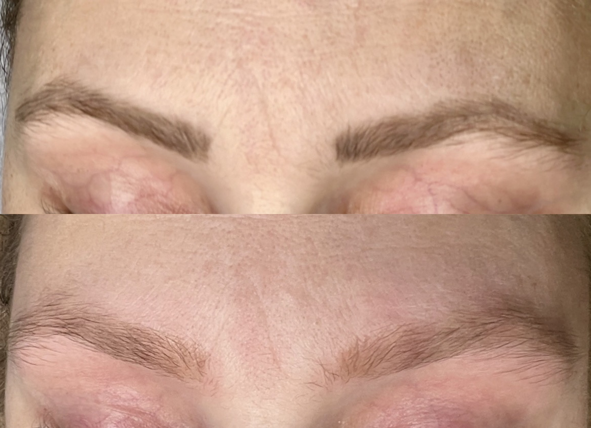 Øyenbryn før og etter laserbehandling av gammel permanent makeup